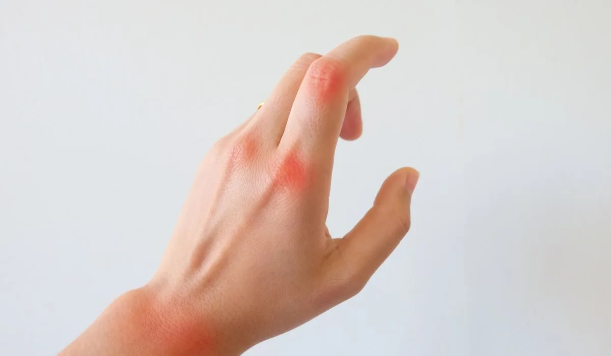 A hand showing glowing red areas on the joints and wrists highlighting arthritis pain.